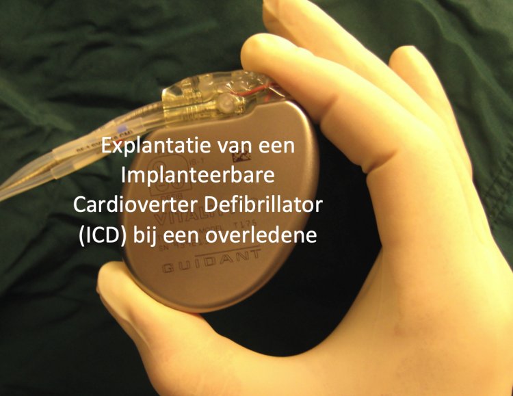 ICD protocol postmortum explantatie