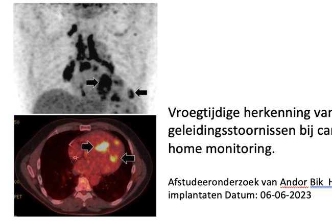 Vroegtijdige herkenning ritme-/geleidingsstoornissen bij cardiale sarcoidose